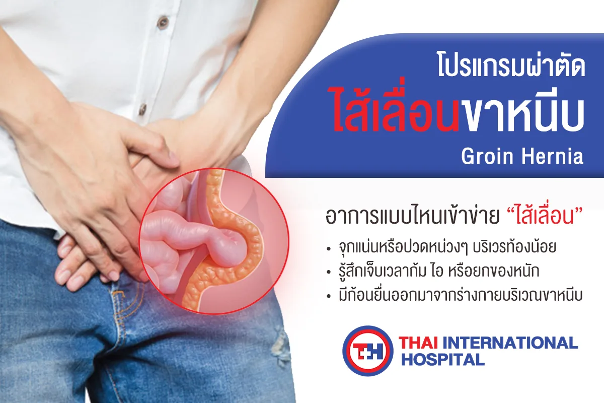 ไส้เลื่อน-jpg.webp